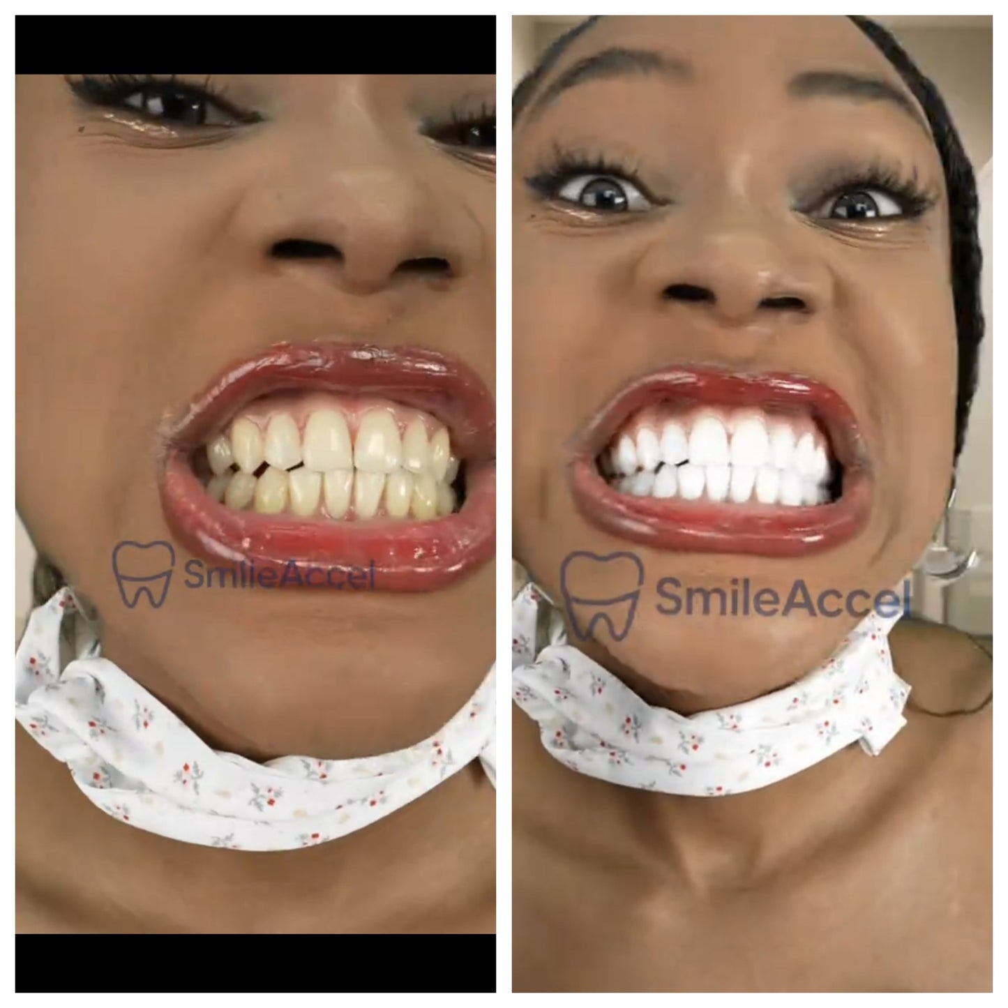 Body Accel Blancheur