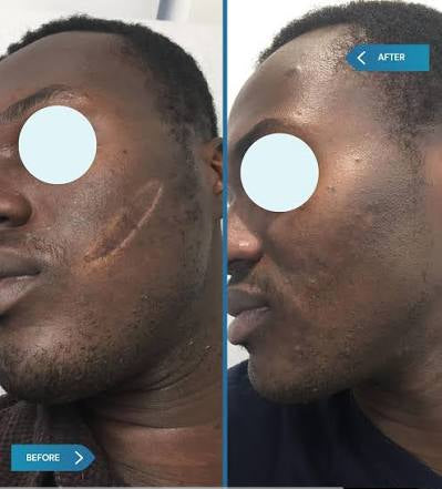 Crème Anti Cicatrice.