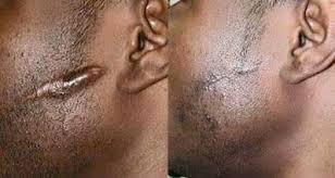 Crème Anti Cicatrice.